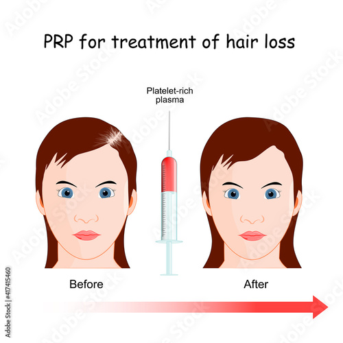 PRP procedure for treatment of hair loss.