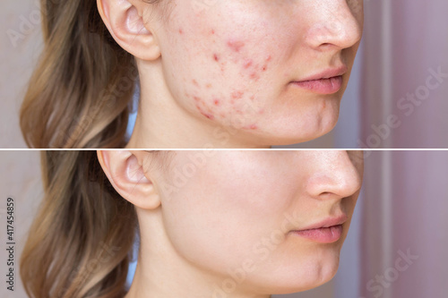 Cropped shot of a young woman's face before and after acne  treatment on face. Pimples, red scars on the cheeks and chin of the girl. Problem skin, care and beauty concept. Dermatology, cosmetology photo