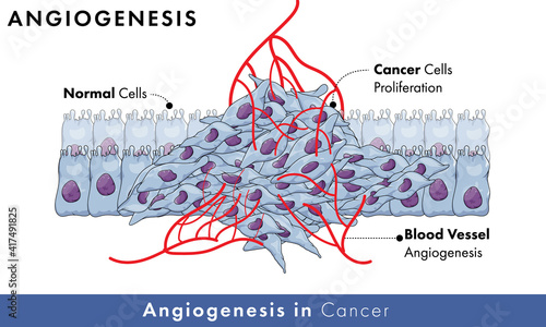 Growth of blood vessel in cancerous tissue or cells which is also known as angiogenesis with normal cells in background,.
