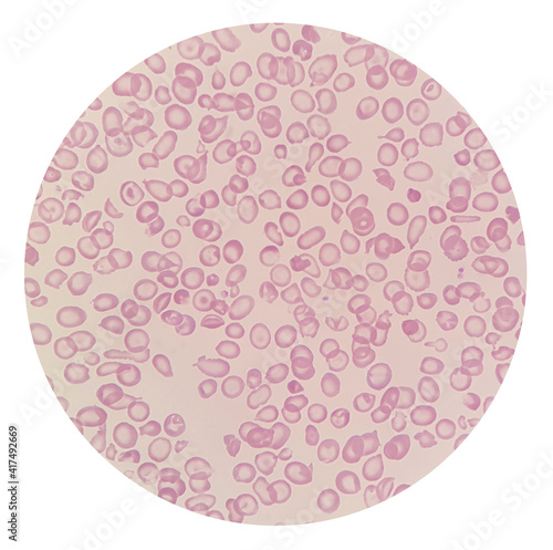 Microscopic images of abnormal red blood cells from thalassemia patient. Erythrocytes morphology in thalassemia.