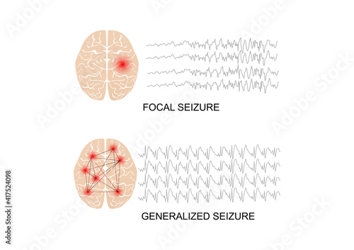Illustration of seizure types demonstrating by onset and brain waves