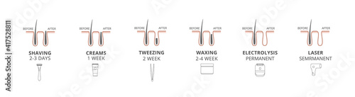 Procedure hair removal, before and after depilation a vector illustrations.