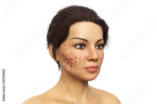 Acne vulgaris on skin photo