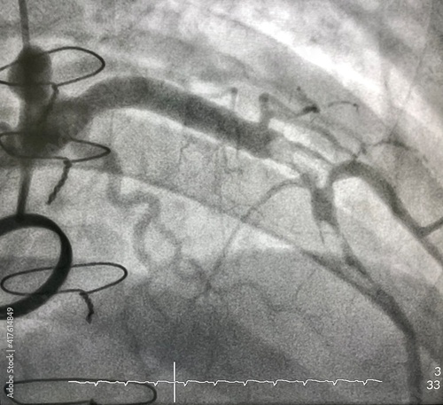 coronary angiogram shown massive thrombus that occluded left anterior descending artery (LAD) in patient with ST elevation myocardial infarction (STEMI) who undergoing open heart surgery.
