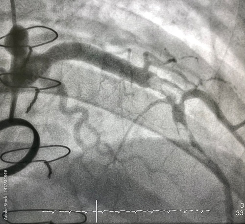 Fotografi coronary angiogram shown massive thrombus that occluded left anterior descending artery (LAD) in patient with ST elevation myocardial infarction (STEMI) who undergoing open heart surgery