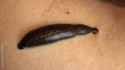 Medical leech on the human body drink blood. Treatment with leeches. Macro video.
