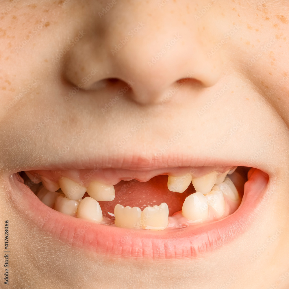 Fototapeta premium close-up of a child's face with lost front teeth