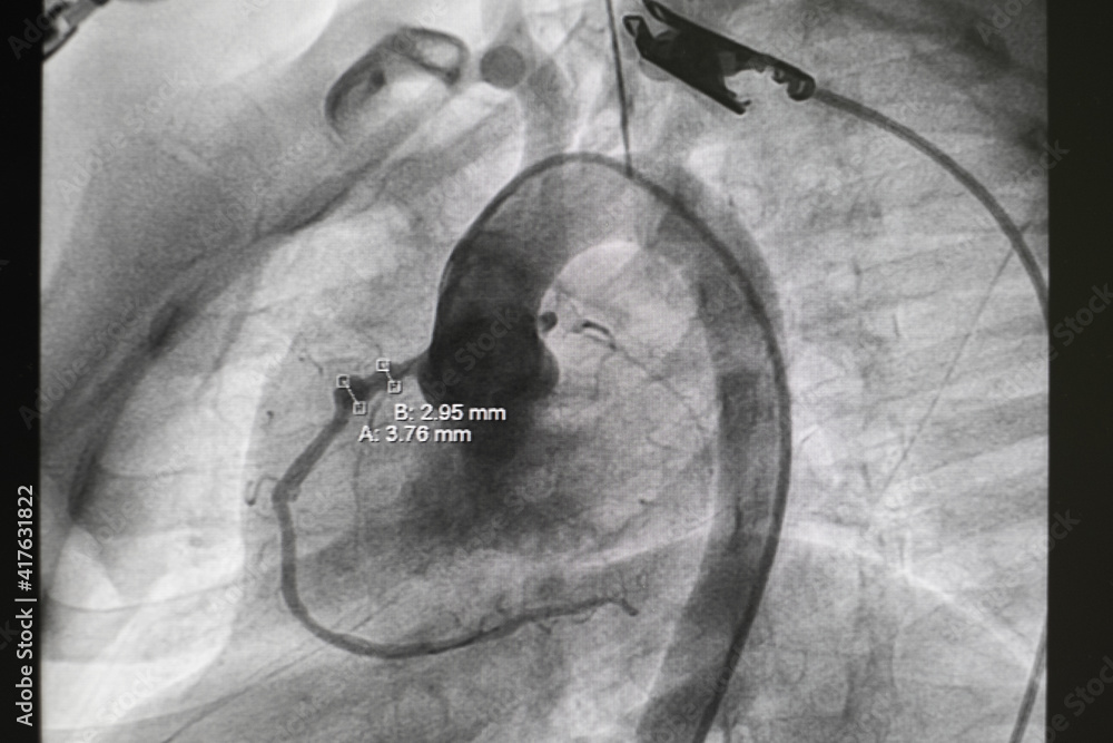 pediatric angiography. Aortography showed patent ductus arteriosus (PDA), which is congenital