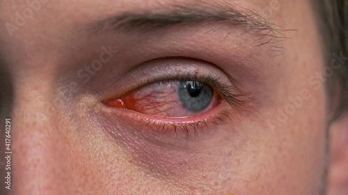 Close up of annoyed red blood blue eye of male affected by conjunctivitis or after flu, cold or allergy. Concept of health, disease and treatment. Irritated eye full with capillar net