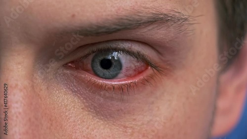 Close up of annoyed rotating red blood blue eye of male affected by conjunctivitis or after flu, cold or allergy. Concept of health, disease and treatment. Irritated eye full with capillar net