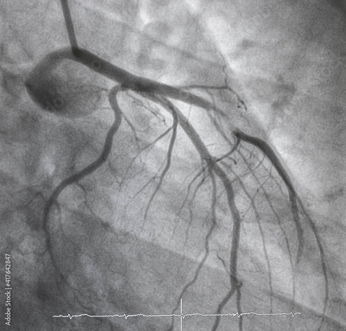 Coronary angiogram , medical x-ray for heart disease. Coronary artery disease.	 photo