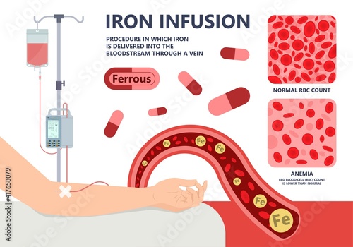 Iron infusion for anemia IV treat level red blood cells RBC loss low supplement