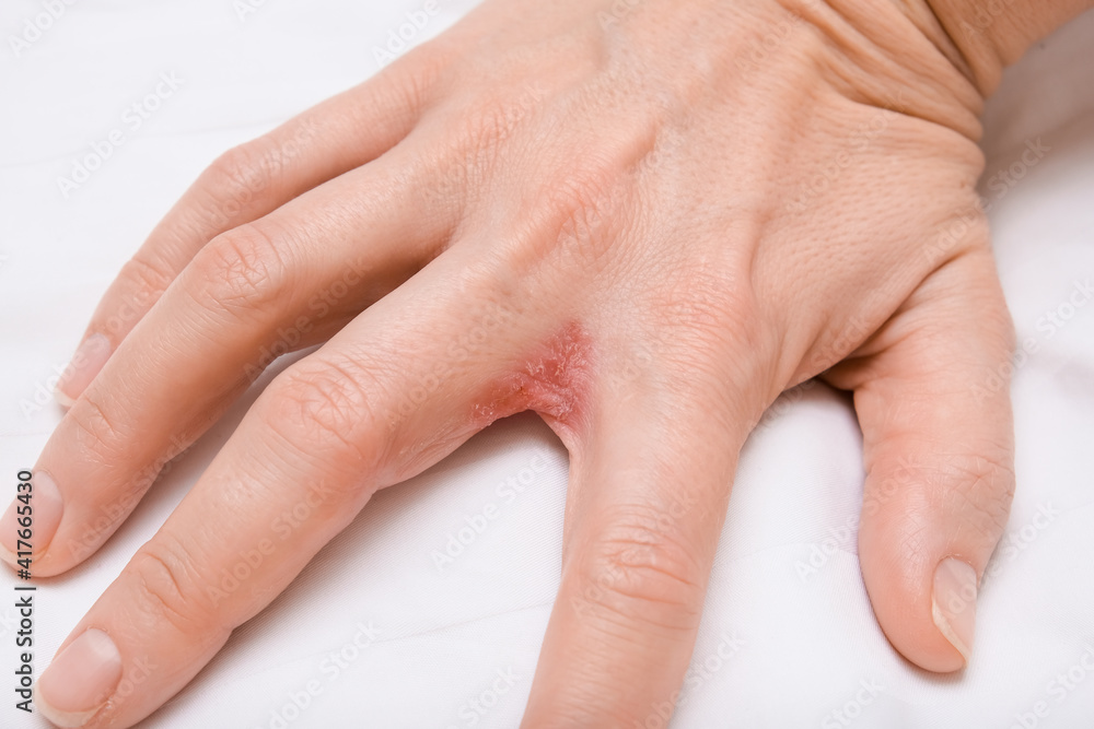 Dyshidrotic Eczema Dyshidrosis Symptoms Causes 52 OFF