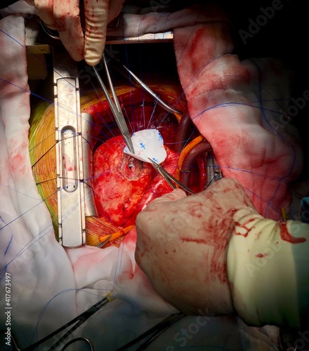 Obraz na płótnie Surgeon used dacron patch for closure of Ventricular septal rupture (VSR) in acute myocardial infarction (MI) patient with cardiopulmonary bypass (CPB) support