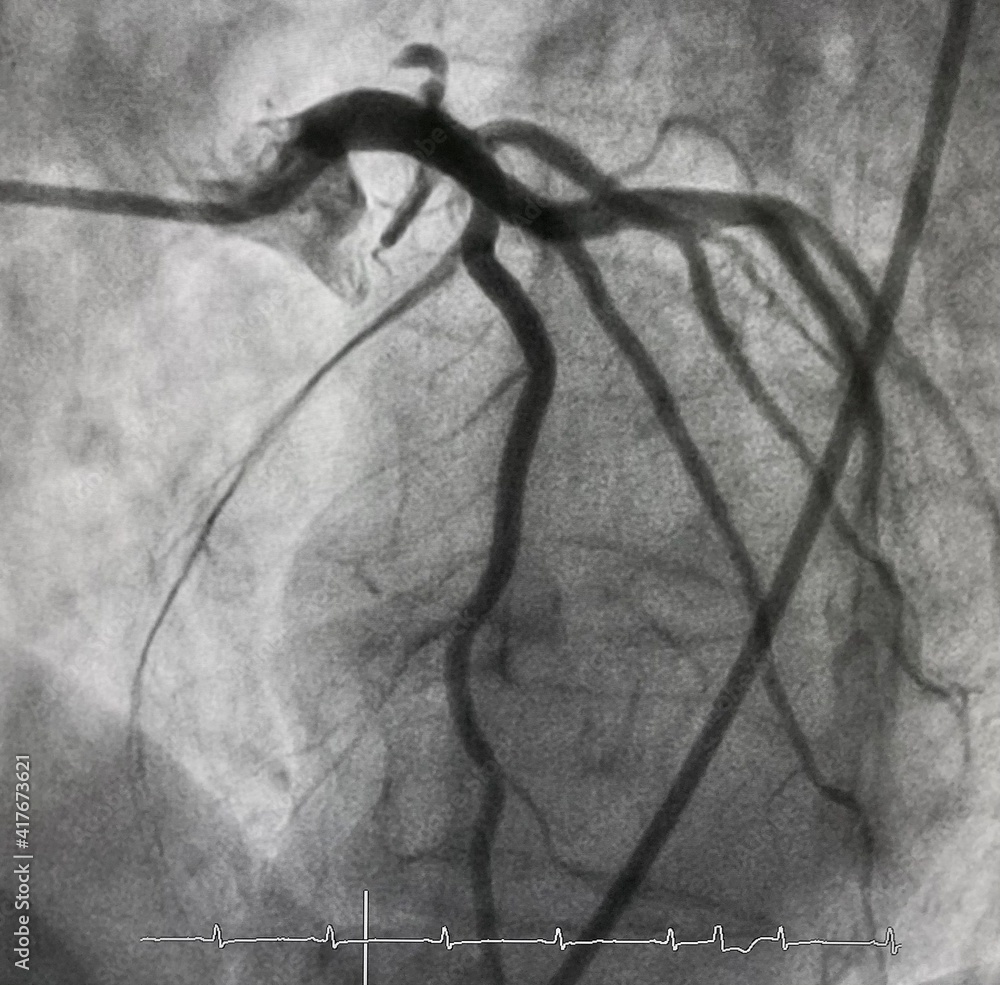 Obraz premium coronary angiogram of left coronary artery with arteriovenous (AV) fistula from left anterior descending artery (LAD).