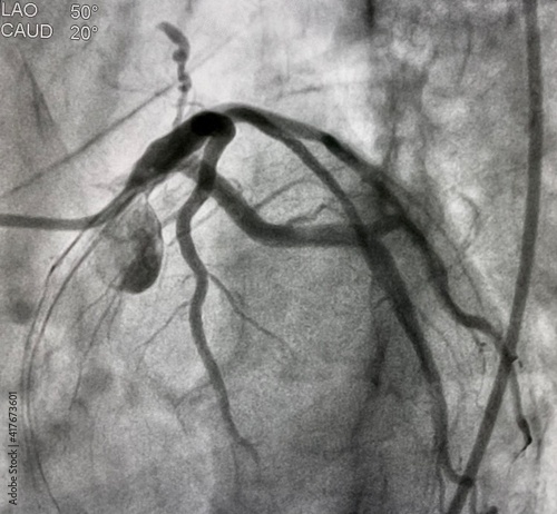 coronary angiogram of left coronary artery with arteriovenous (AV) fistula from left anterior descending artery (LAD).
