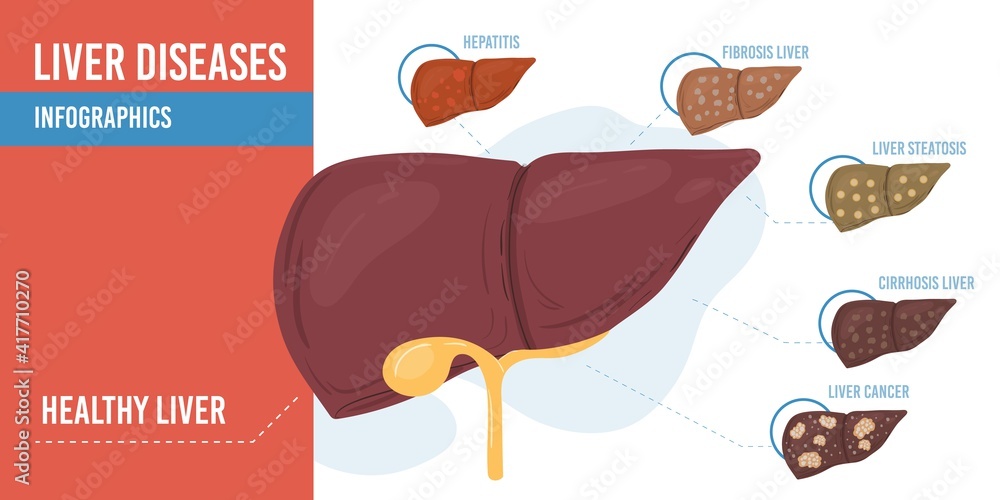 Vector flat cartoon infographic,healthy liver and list of diseases-human internal organs diagnostics,medical treatment and therapy concept