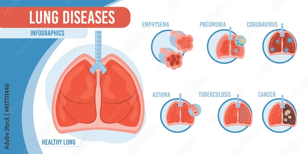 Vector flat cartoon infographic,healthy lungs and list of diseases,coronavirus-human internal organs diagnostics,medical treatment and therapy concept