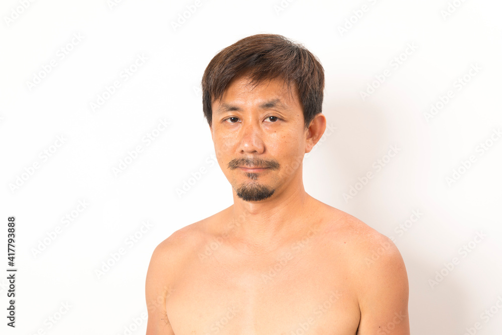Fototapeta premium Asian man with sunburned skin and face on white background.