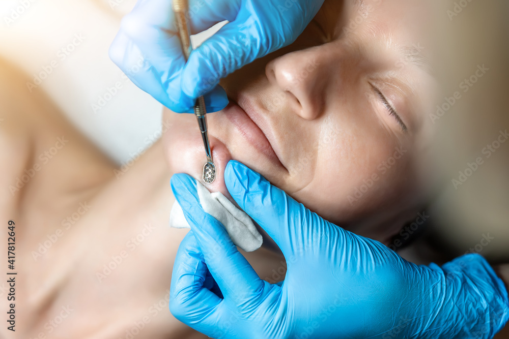 Close-up detail of beautician doctor hand in blue rubber protective gloves make blackhead spot pimples removal procedure for young adult female patient. Woman facial cleansing and skin care concept Close-up detail of beautician doctor hand in blue rubber protective gloves make blackhead spot pimples removal procedure for young adult female patient. Woman facial cleansing and skin care concept