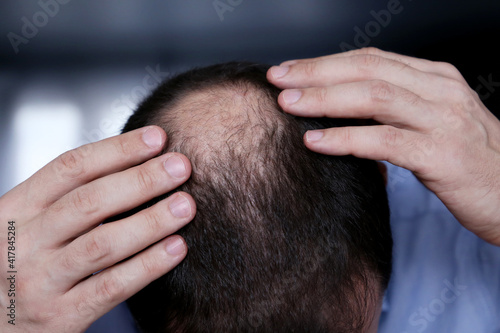 Baldness, man concerned about hair loss. Male head with a bald, selective focus on hand