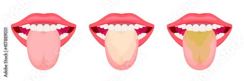 Tongue with a white coating and clean. Oral hygiene. Vector illustration isolated on white background