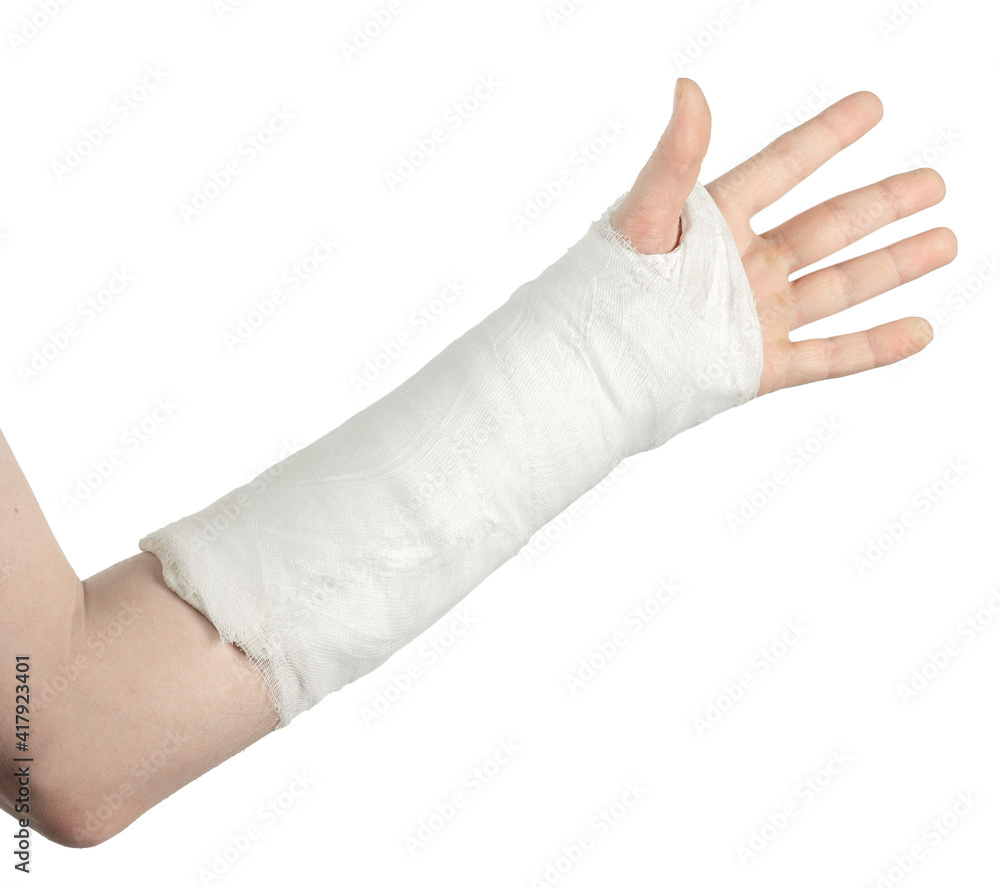 Broken arm, on a white background Broken arm, on a white background