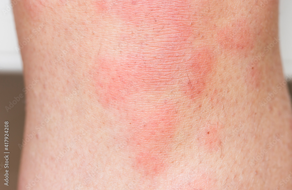 Hives on skin, urticaria rash, skin allergies, UK Stock Photo | Adobe Stock