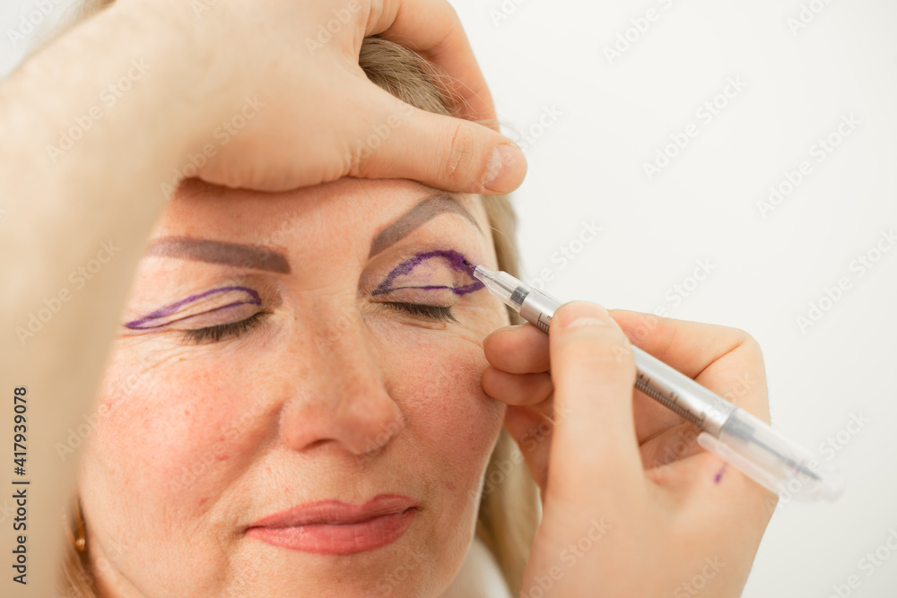 Blepharoplasty markup close-up on the face before the plastic surgery operation for modifying the eye region of the face in medical clinic. Doctor doing plastic cosmetic operation Blepharoplasty markup close-up on the face before the plastic surgery operation for modifying the eye region of the face in medical clinic. Doctor doing plastic cosmetic operation