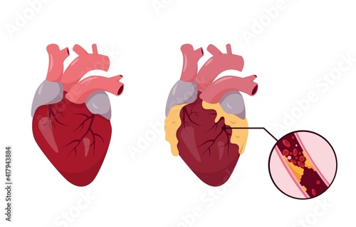 Healthy and unhealthy human Heart.