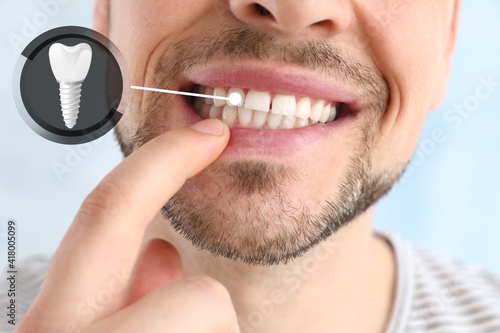 Man showing implanted teeth on light background, closeup photo