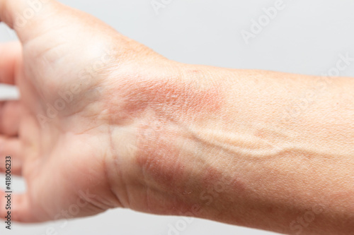 thermal burn of the skin on the arm