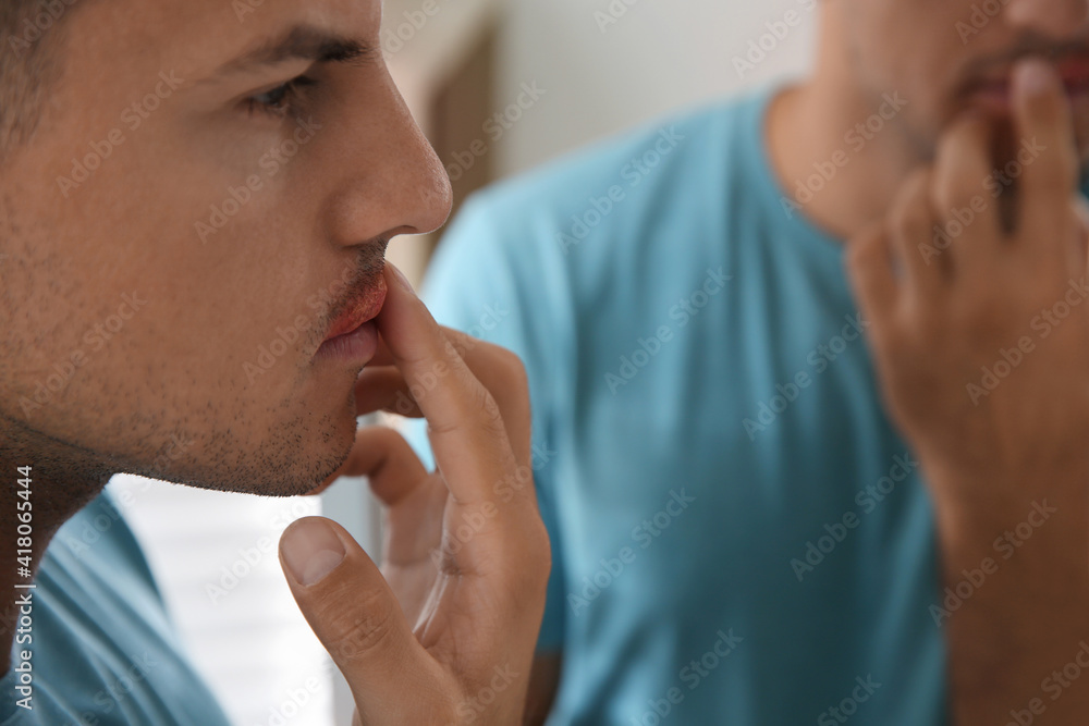 Man with herpes touching lips in front of mirror, closeup Man with herpes touching lips in front of mirror, closeup