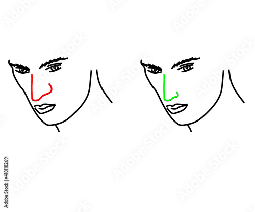 The man's face and the reshaping of the nose. Rhinoplasty. Vector illustration.