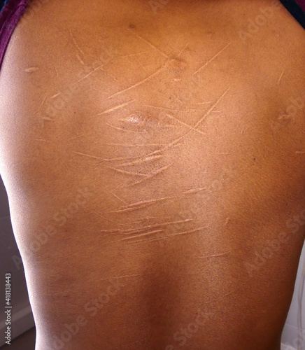 Canvas Print religious ritual spanking, whipping, lacerations and scars on the back of a youn