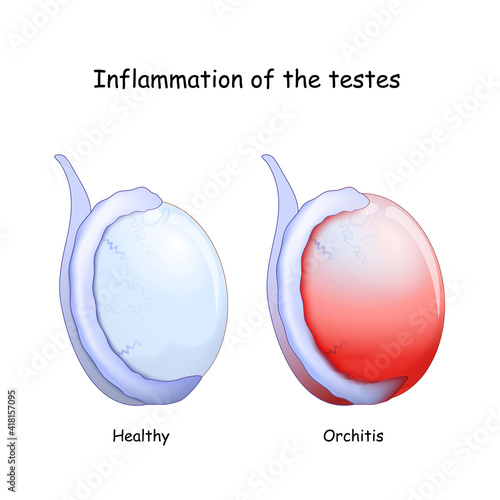 Healthy testicle and testicle with Orchitis