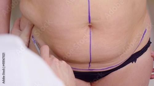 Abdominoplasty markup before plastic operation to reduce the abdomen and remove cellulite. Correcting body shape. Surgeon does liposuction for patient in medical clinic photo
