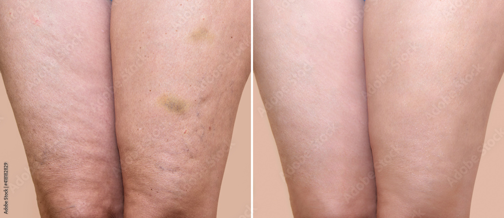 Thighs Of A Woman With Cellulite And Bruises Before And After Medical Thighs Of A Woman With Cellulite And Bruises Before And After Medical