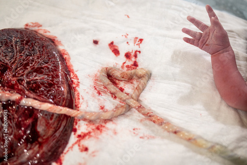 Closeup of a human placenta and a newborn child'd hand on bedsheets in the hospital