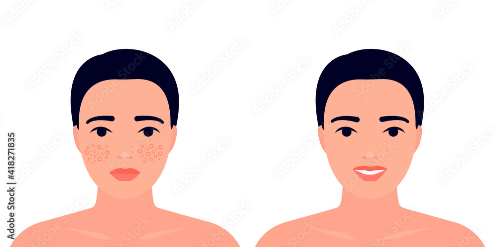 Woman before and after acne on skin face treatment. Inflamation skin, spot and pimple. Dermatology, cosmetology problem. Skin care, higiene, clean. Vector illustration Woman before and after acne on skin face treatment. Inflamation skin, spot and pimple. Dermatology, cosmetology problem. Skin care, higiene, clean. Vector illustration