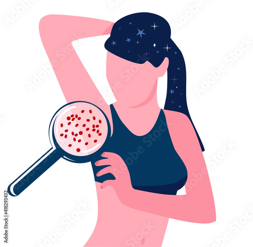 Skin problems because of Wrong shaving or depilation. Comedones and clogged pores. Ingrown hair. Strawberry armpit. Young woman in sportswear.Magnifier zooms inflammation.Vector illustration