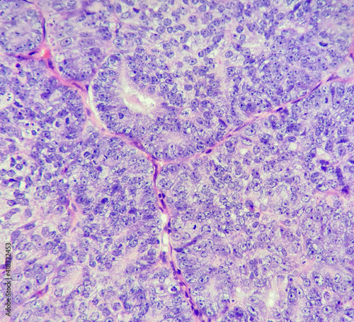 Photo of endometrial adenocarcinoma, showing endometrioid subtype, magnification 400x, photo under microscope photo