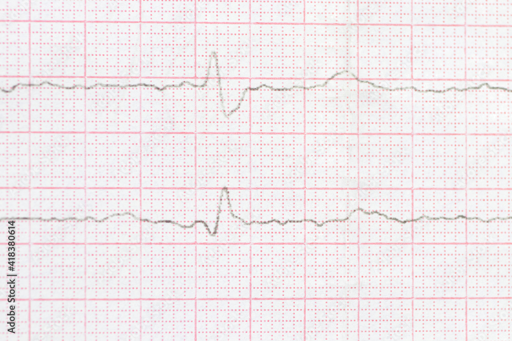 Macro or close-up ECG cardiogram of a patient with left bundle branch block. Diagnosis and treatment of heart disease Macro or close-up ECG cardiogram of a patient with left bundle branch block. Diagnosis and treatment of heart disease