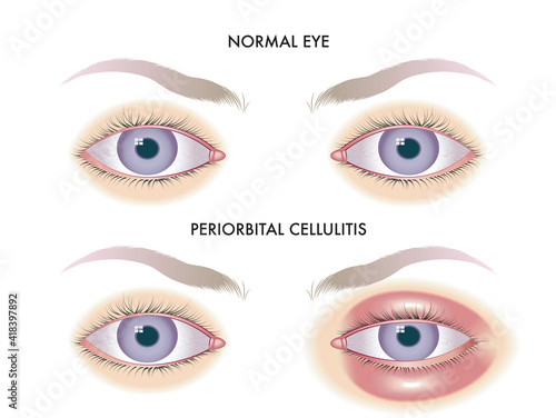 Medical illustration shows the comparison between normal eyes and those affected by periorbital cellulitis. 