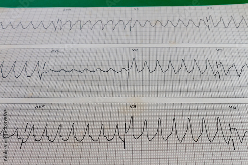 Fotografie Electrocardiogram of a patient with high-rate cardiac arrhythmia