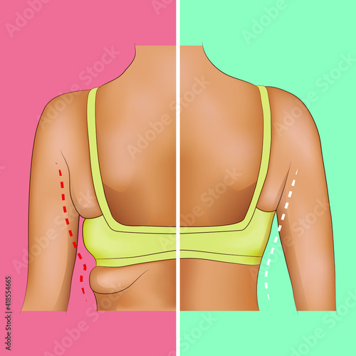 Armpits fat before and after sport, diet or surgery
