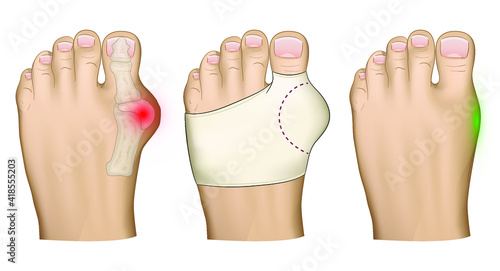 Illustration of the Hallux valgus problem. Treatment with a bandage of the protruding bone on the leg.Anatomical image of the foot