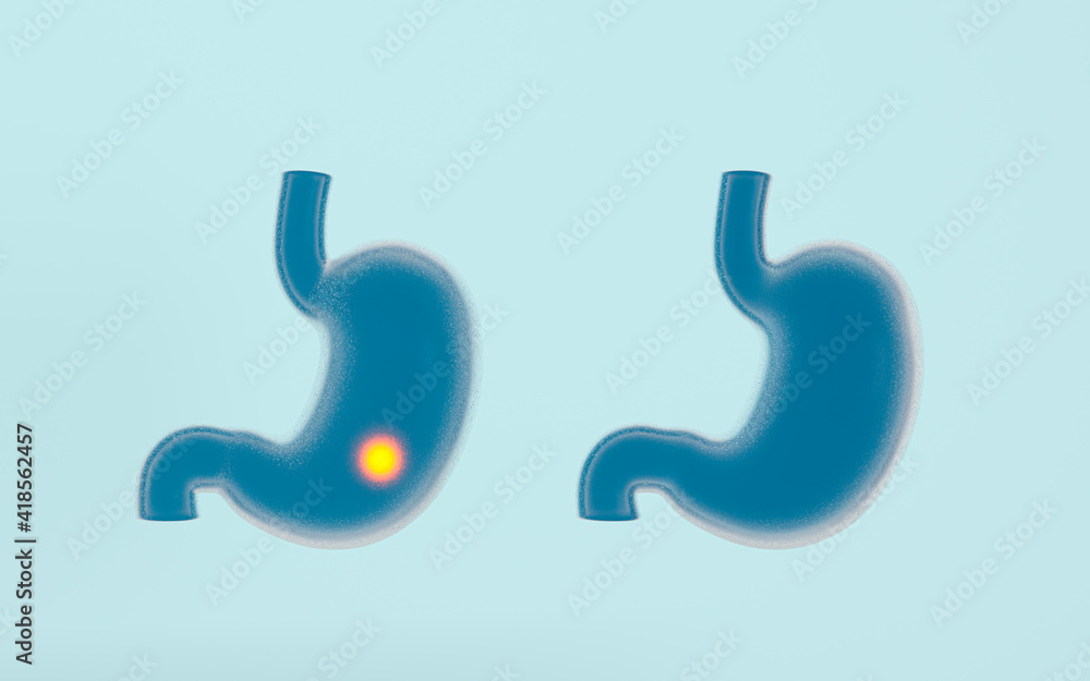 Human Internal Stomach with pain illness, 3d rendering. Human Internal Stomach with pain illness, 3d rendering.