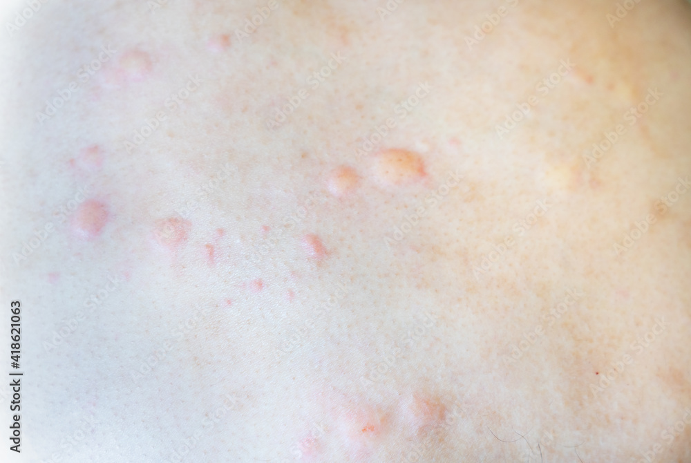 蕁麻疹が出ている成人男性の肌の写真。皮膚病の写真。