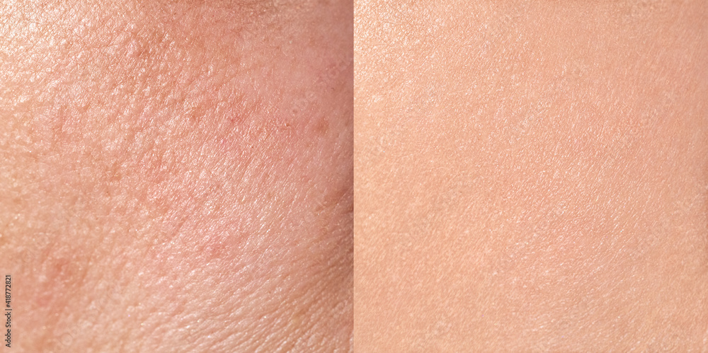 Skin care procedure Skin care procedure